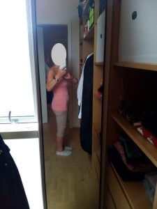 6 mėnesiai po operacijos